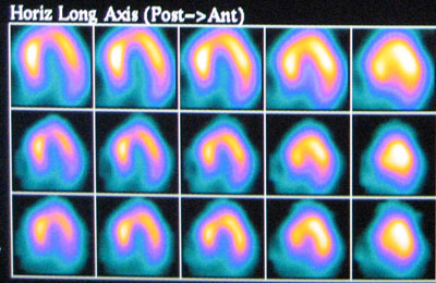 test function for heart Stress Valley Testing Exercise Cardiology   Merrimack